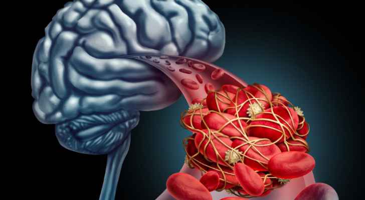 دراسة جديدة تسهم في علاج مرضى السكتة الدماغية