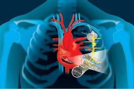 جهاز لتنظيم ضربات القلب بلا بطارية